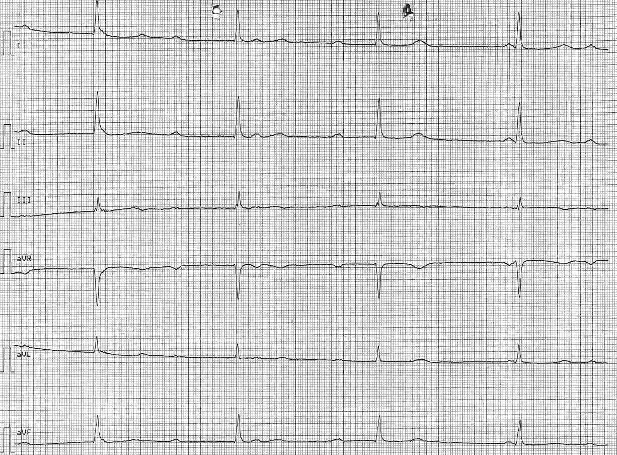 EKG-Quiz