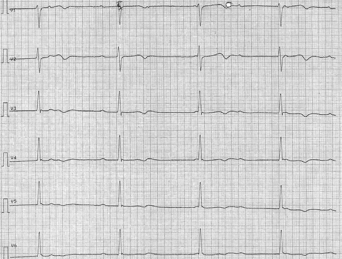 EKG-Quiz