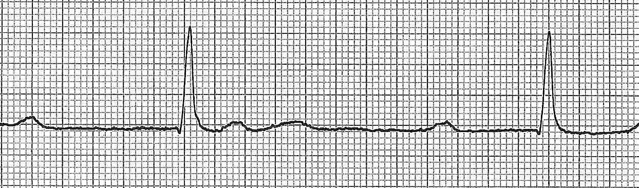 EKG Quiz