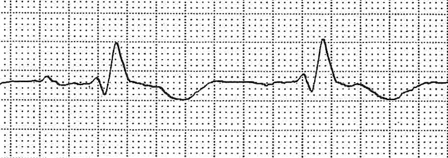 EKG Quiz