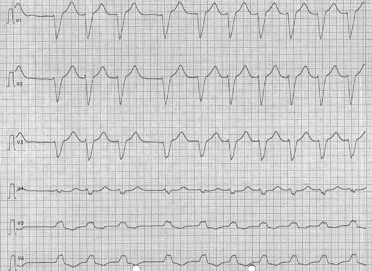 EKG-Quiz