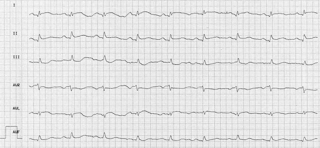 EKG-Quiz